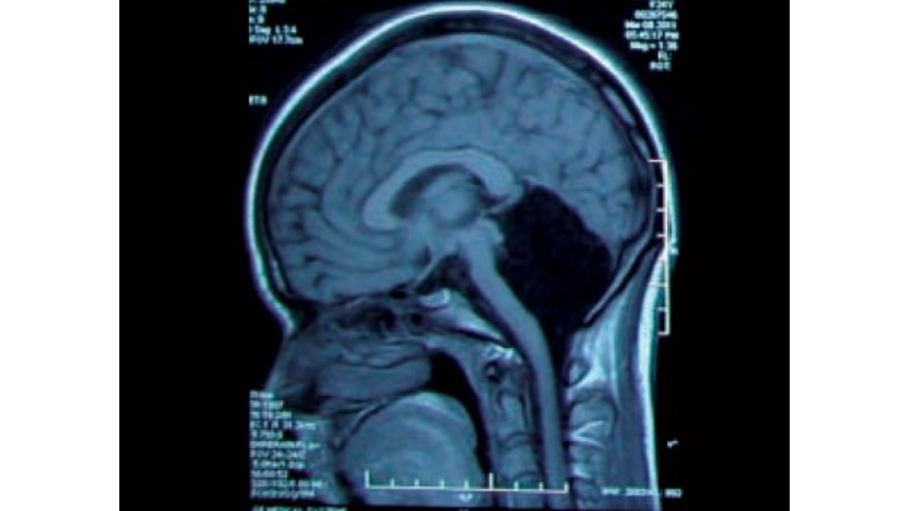 evli kadının beyin tomografisi